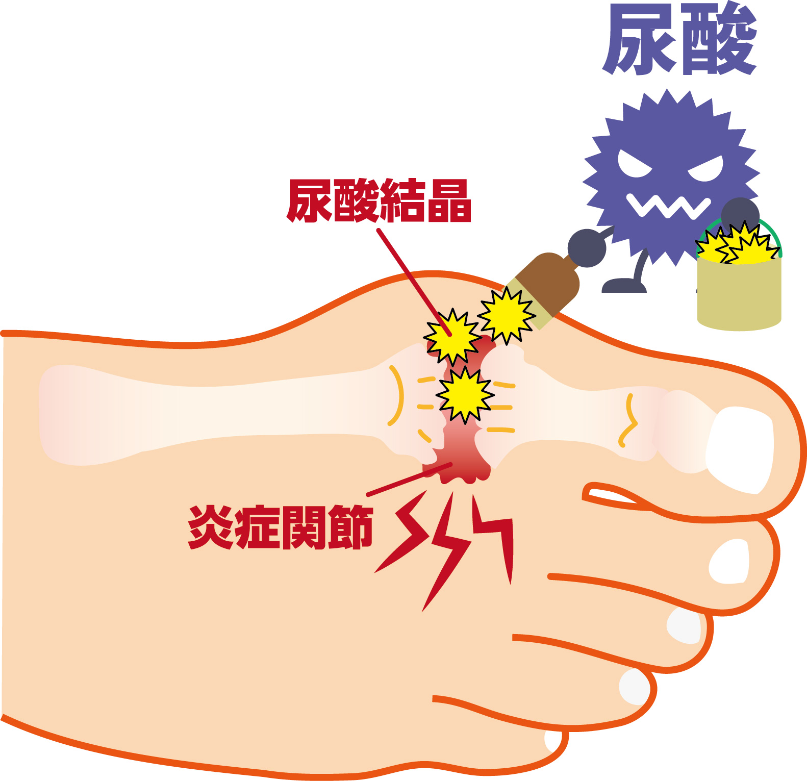 痛風発作