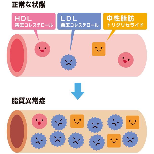 脂質異常症とは